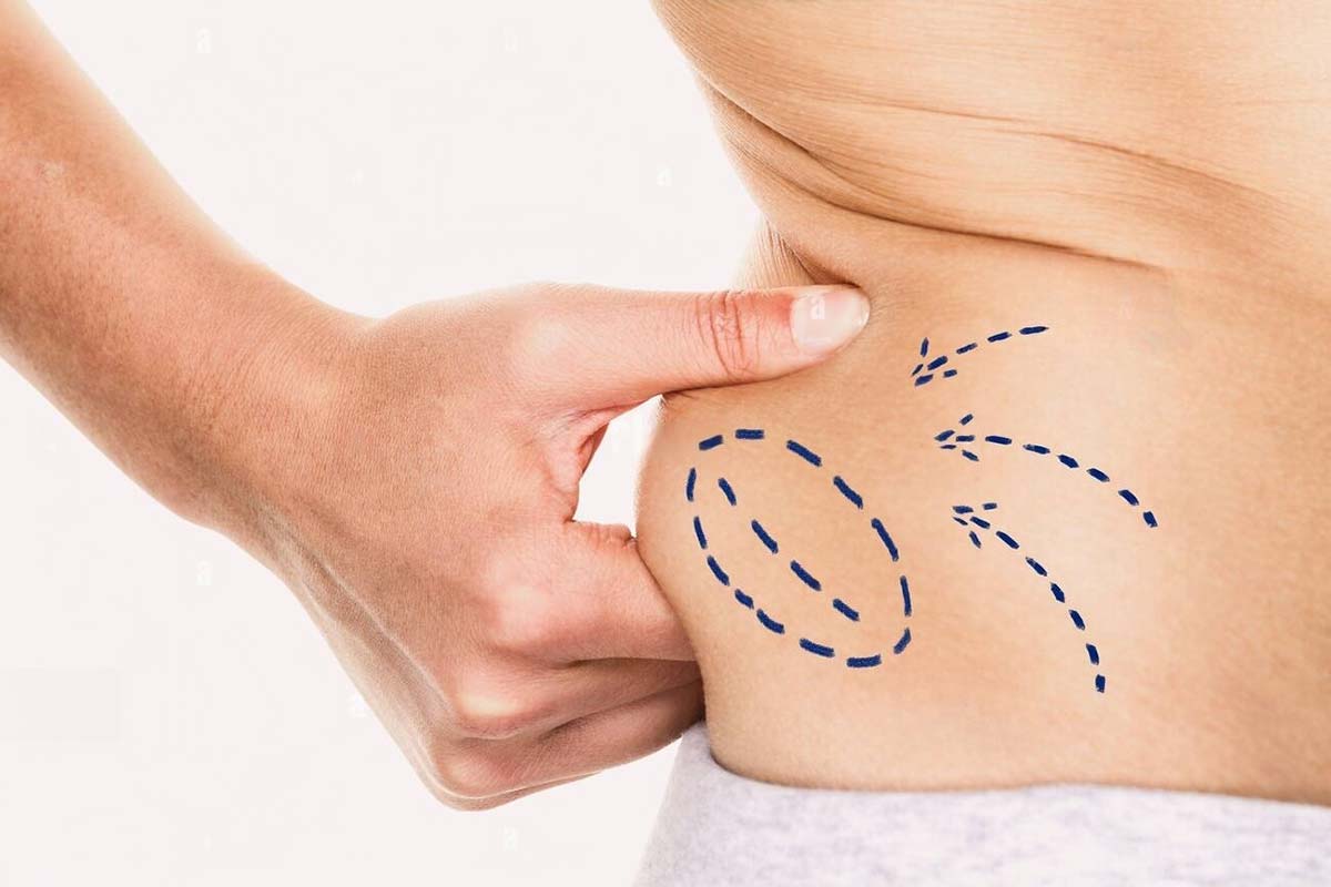 Body Contouring - Burlington Plastic Surgery