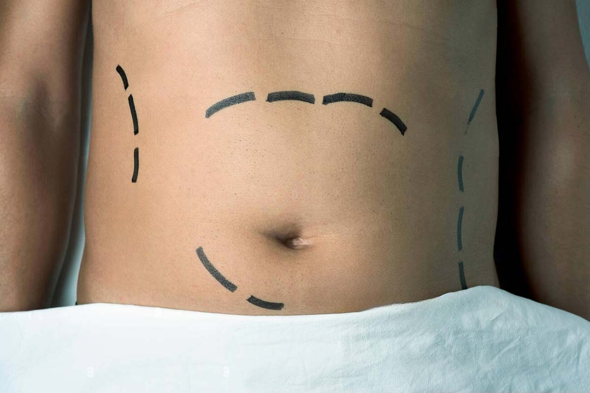 Tummy tuck surgery in Hamilton and Burlington, Ontario