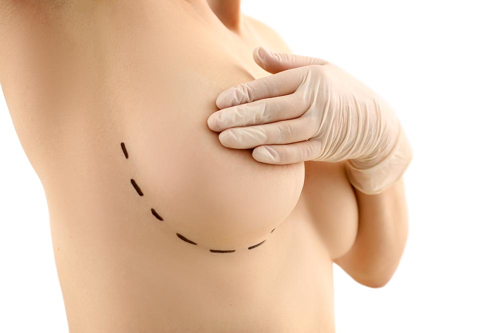 Breast Lift Burlington