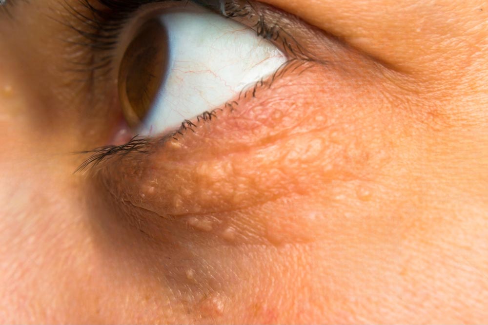 Xanthelasma and Removing Eyelid Cholesterol Deposits - Burlington Plastic  Surgery