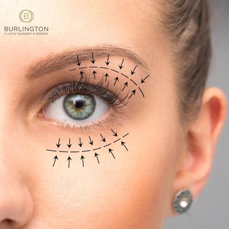 Unveiling a Radiant You: The Artistry of Eyelid Surgery at Burlington Plastic Surgery