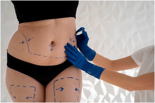 Tummy Tuck Truths: A Journey to Sculpted Perfection Revealed